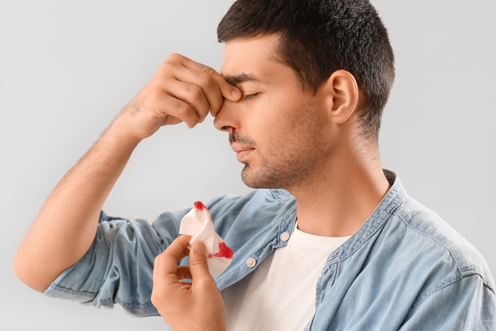 Young man with nosebleed and tissue on light background.